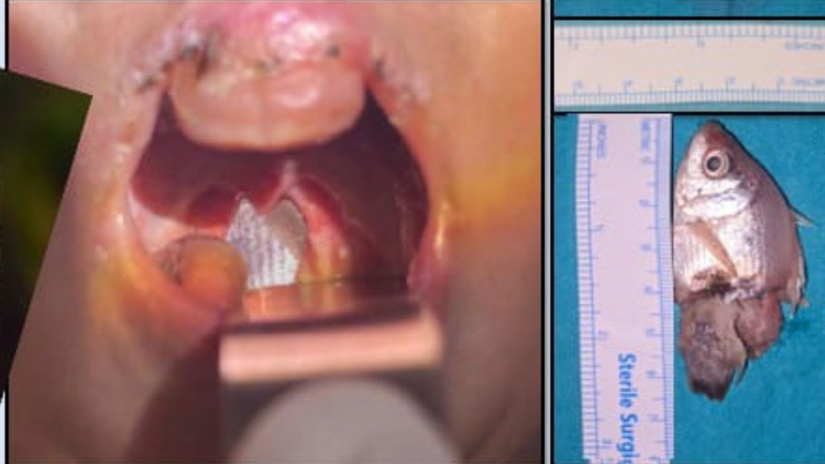 इंदौर के बच्चे की गले में फंसी 2 सेमी की जीवित मछली, डॉक्टरों ने बचाई जान
