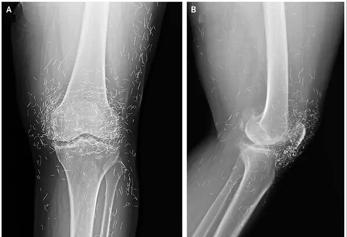 woman knee pain gold threads