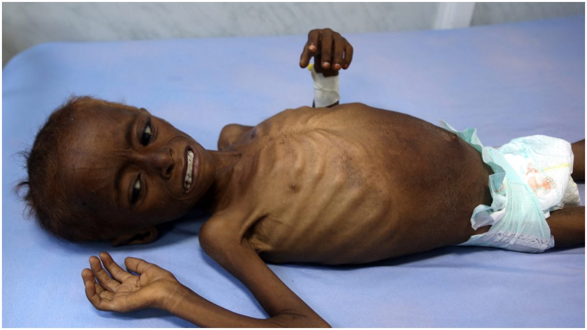 यमन में आई भुखमरी की तस्वीर यमन में आई भुखमरी की तस्वीर