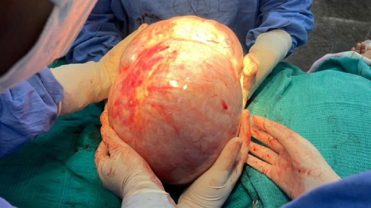 सात किलो का ट्यूमर