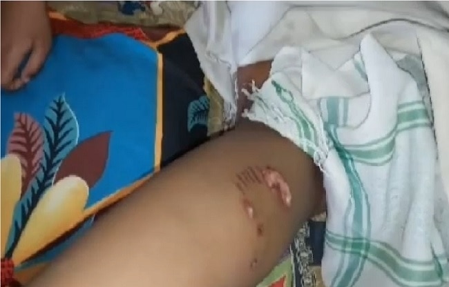 बच्चे के शरीर के जख्म.