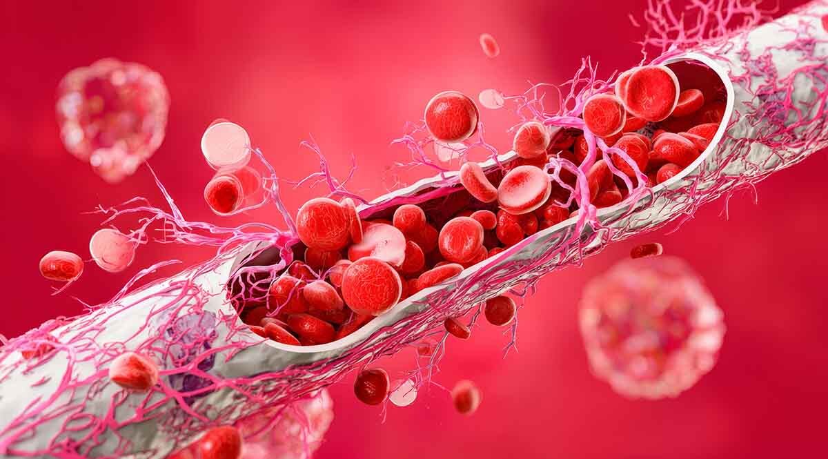 Cracked Vessels, Clot Risk