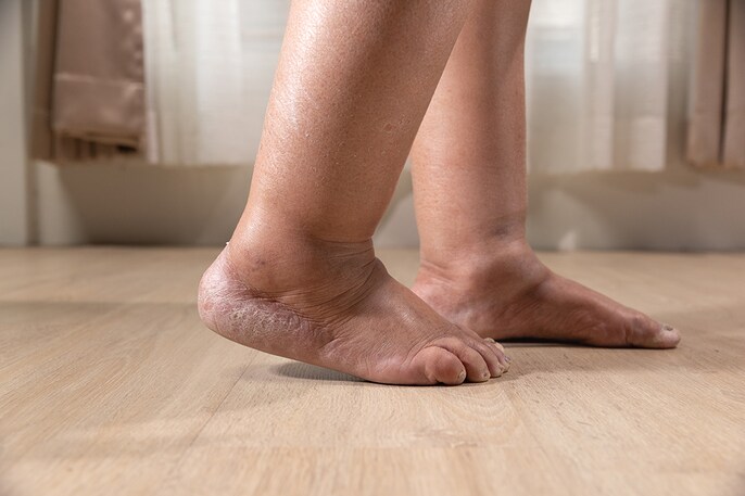 Ballooned Ankles Ballooned Ankles