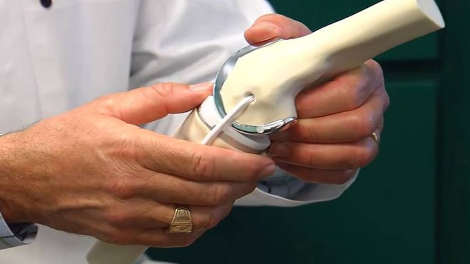 NPPA says cap on knee implant prices to end profiteering NPPA says cap on knee implant prices to end profiteering