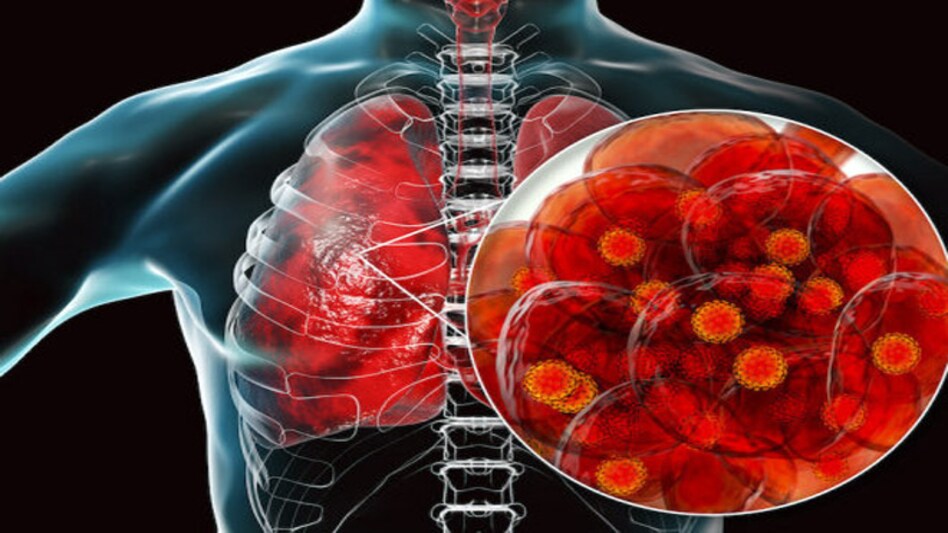 COVID-19 affecting lungs; representational COVID-19 affecting lungs; representational