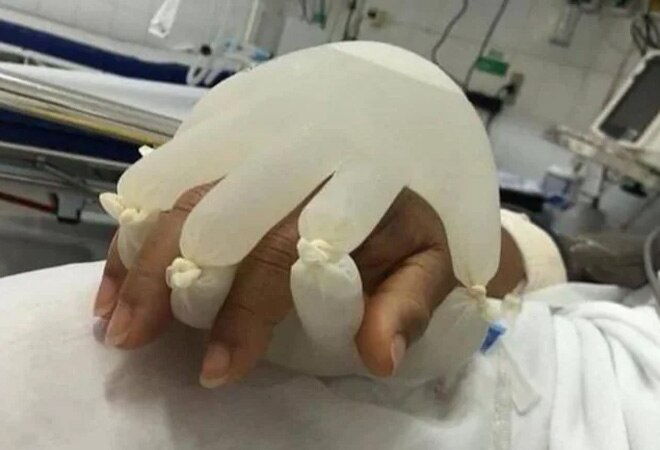 The nurses used two disposable gloves and tied them up after filling them with hot water (Photo credits: Twitter) The nurses used two disposable gloves and tied them up after filling them with hot water (Photo credits: Twitter)