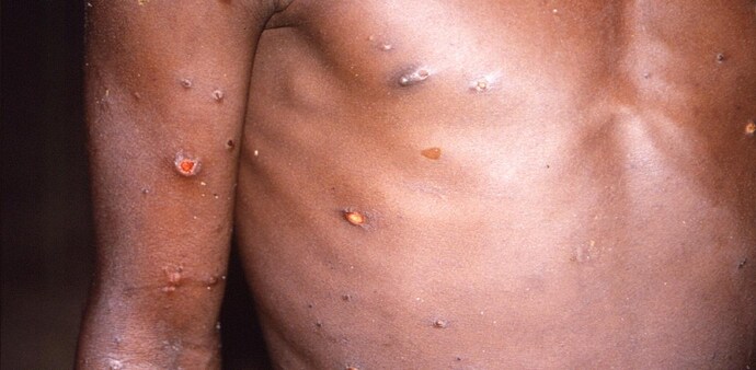 Monkeypox is a virus that causes fever symptoms as well as a distinctive bumpy rash. It is usually mild. Monkeypox is a virus that causes fever symptoms as well as a distinctive bumpy rash. It is usually mild.