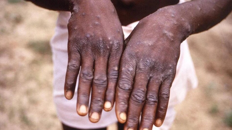 The US Centers for Disease Control and Prevention is preparing for the possibility of more cases of monkeypox, a virus that belongs to the orthopoxvirus family. The US Centers for Disease Control and Prevention is preparing for the possibility of more cases of monkeypox, a virus that belongs to the orthopoxvirus family.