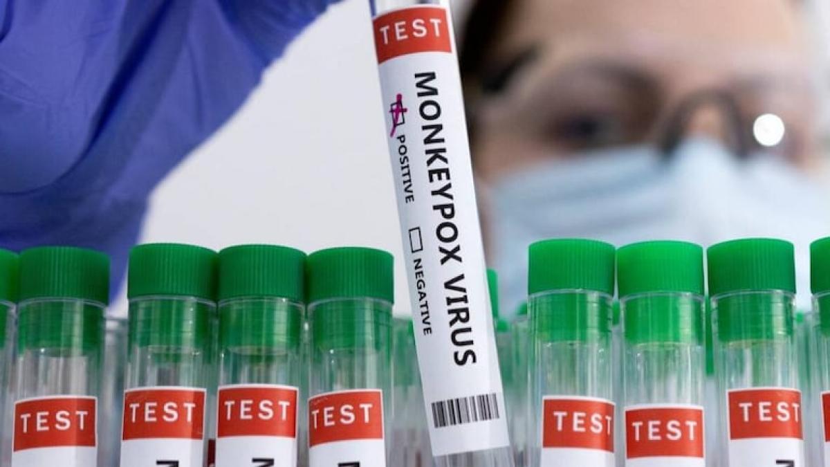 Monekypox: Suspected case reported in Noida Monekypox: Suspected case reported in Noida