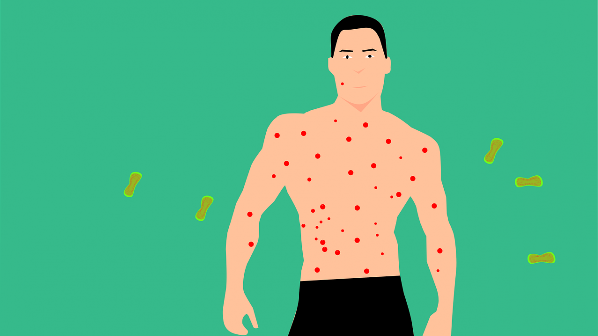 In infected, a patient gets Tomato-shaped blisters on several body parts. The blisters start as red-colored small blisters and resemble tomatoes when they enlarge. In infected, a patient gets Tomato-shaped blisters on several body parts. The blisters start as red-colored small blisters and resemble tomatoes when they enlarge.