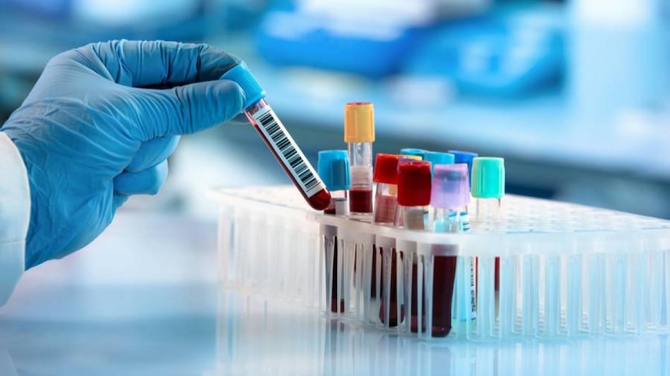 Indian scientists discover blood test to identify risk of Alzheimer’s disease Indian scientists discover blood test to identify risk of Alzheimer’s disease