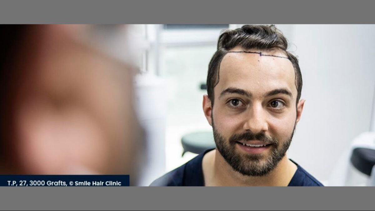 More than 25,000 hair transplants done successfully at Smile Hair Clinic