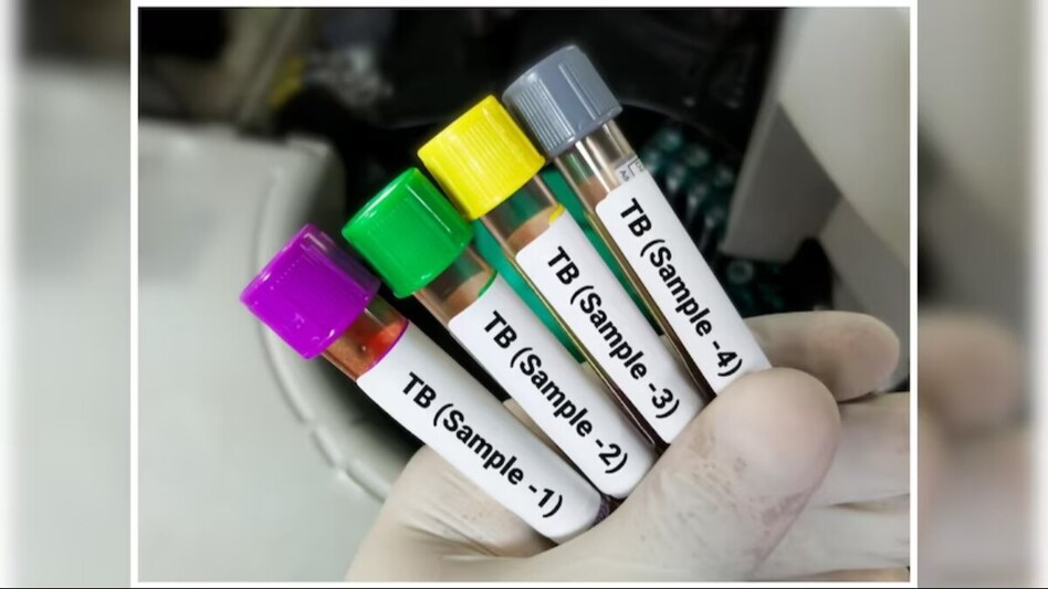 Drug-resistant TB is a major public health challenge in India Drug-resistant TB is a major public health challenge in India