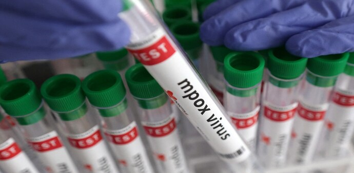 First case of Mpox in India detected in Delhi First case of Mpox in India detected in Delhi