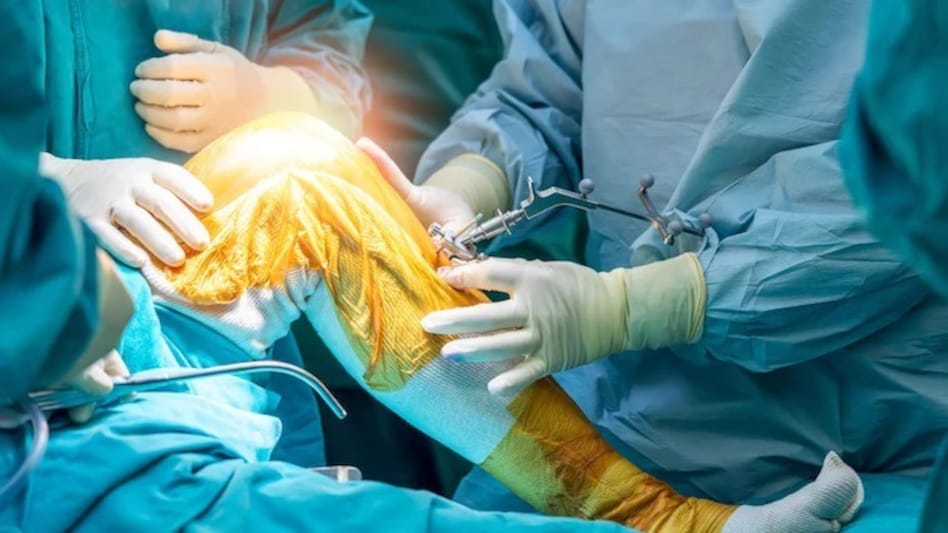 India performs an estimated 2.5 lakh to 3.5 lakh joint replacement surgeries every year. India performs an estimated 2.5 lakh to 3.5 lakh joint replacement surgeries every year.