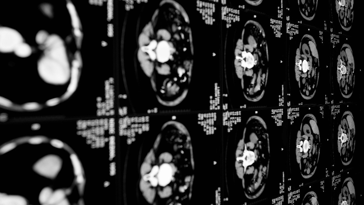 Glenmark-backed IGI advances experimental cancer therapy for solid tumours