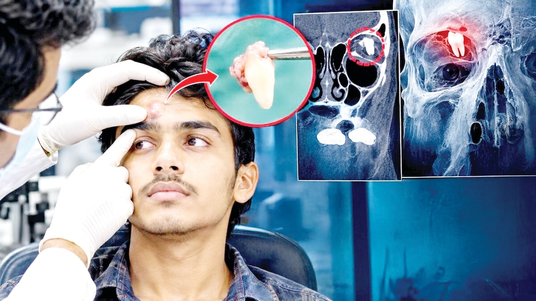 आंख के ऊपर कैसे निकल आया दांत? 16 साल के लड़के के मामले ने डॉक्टरों को चौंकाया