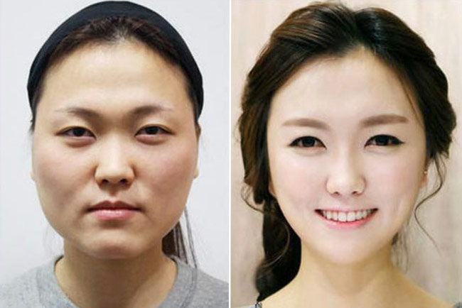 free south korea plastic surgery before and after