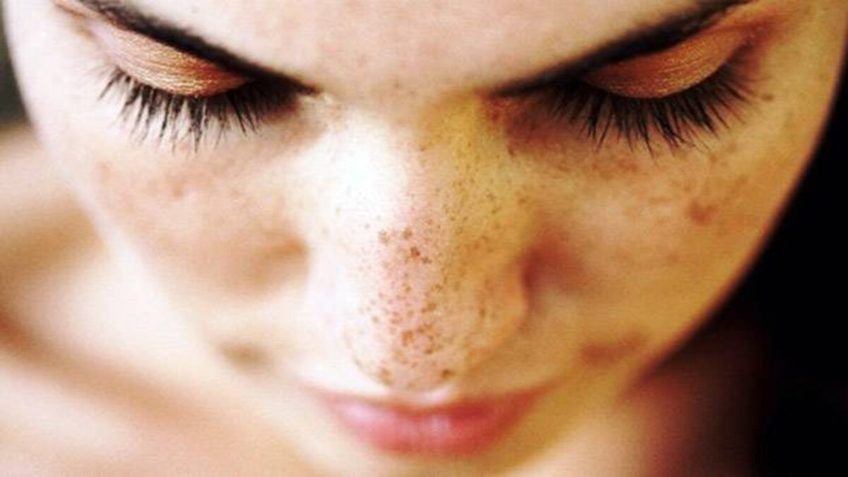 Ladies Struggling With Dark Spots On The Face This Could Be The Reason Lifestyle News