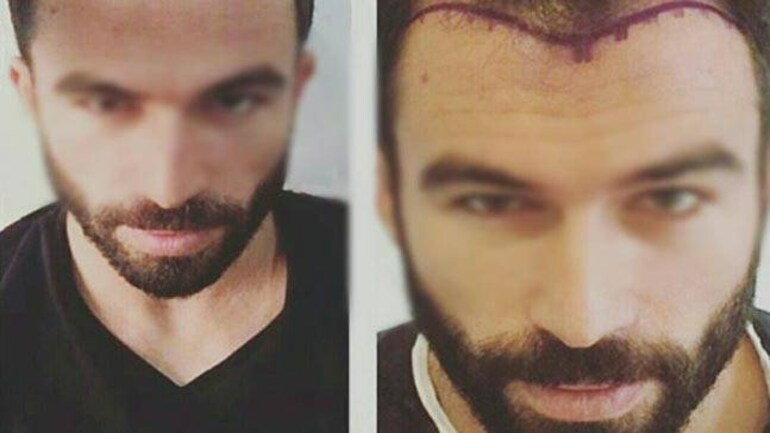 Your Step By Step Guide To A Hair Transplant Lifestyle News