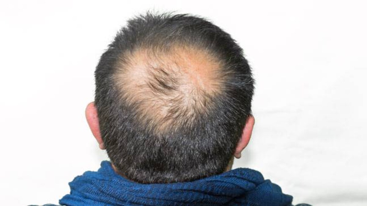 This Guy Grew His Bald Patch Into A Business Lifestyle News