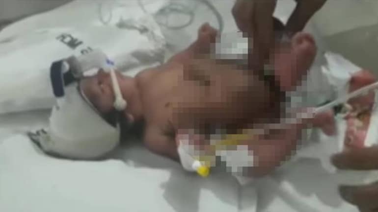 Baby Born With 4 Legs And Extra Genital Mother Says It S Gift From God Fyi News Baby Born With 4 Legs And Extra Genital Mother Says It S Gift From God Fyi News