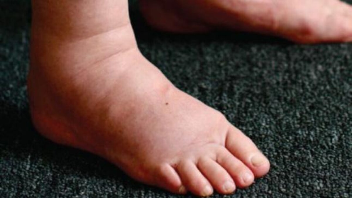 Water Retention Symptoms Causes Treatment Lifestyle News
