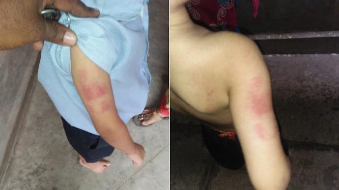 Kindergarten student brutally thrashed by teacher in Hyderabad school