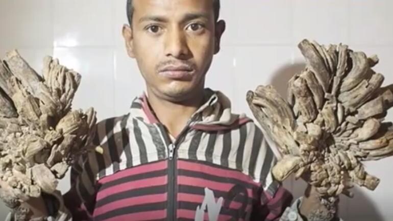 Bangladesh Man Suffering From Tree Man Syndrome Needs More Surgeries World News Bangladesh Man Suffering From Tree Man Syndrome Needs More Surgeries World News
