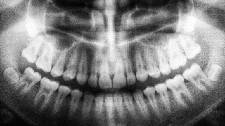 You Might Be Able To Regrow Your Teeth Soon As The Tooth Healing Gene Has Been Identified Education Today News