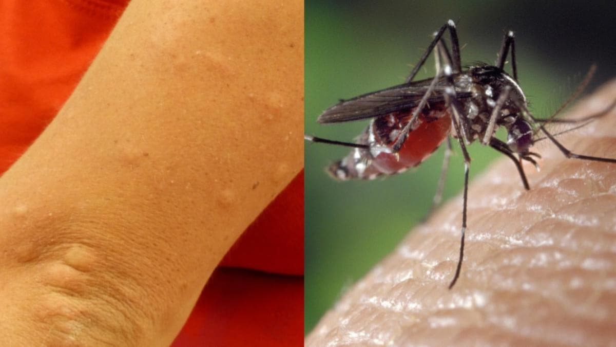 Why do mosquito bites itch? 7 ways to treat mosquito bites and stop the  itching - Information News