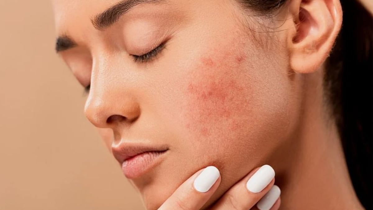 How To Get Rid Of Old Scars Natural Home Remedies Information News
