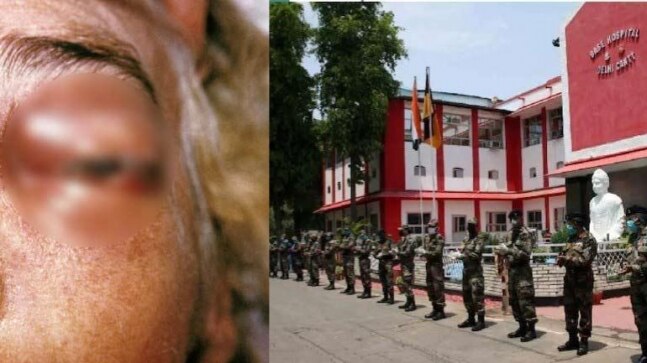 Black fungus eruption hits serving soldiers at Delhi's army hospitals, struggle on for drugs - Vimarsana News