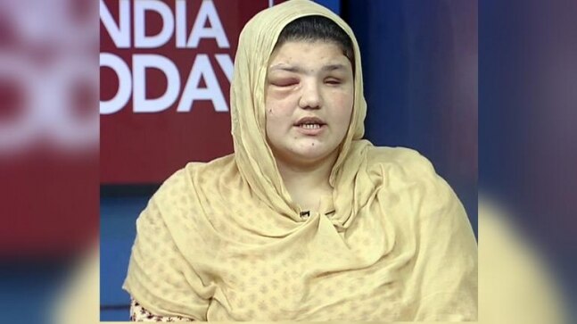 Shot in the head, eyes gouged out: Former Afghan policewoman recounts Taliban attack on her