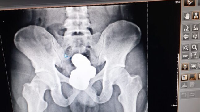 Passenger carrying 900 gm gold paste in rectum nabbed at Imphal airport - Vimarsana News