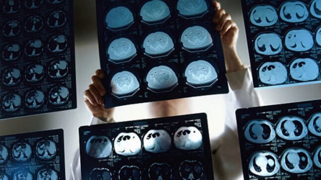 Stroke likely to become more severe in Covid-infected people, say AIIMS doctors - Vimarsana News