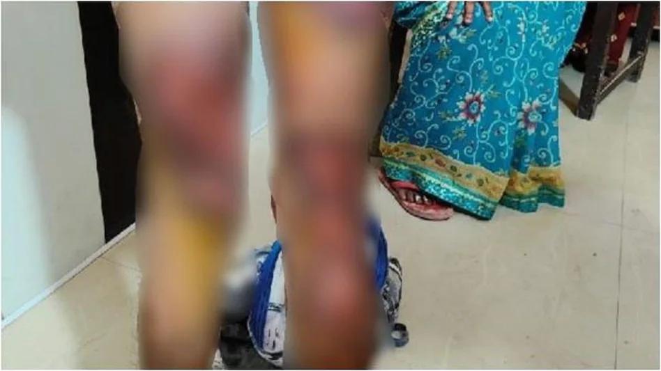 Lucknow: Dalit youth brutally thrashed by cops, alleges third-degree torture