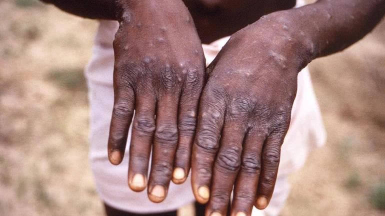 New strain of monkeypox identified in the UK New strain of monkeypox identified in the UK