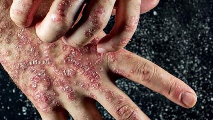 Frequent infections, as well as major bacterial/ viral infections, can act as a trigger for a variety of autoimmune diseases autoimmune disorder