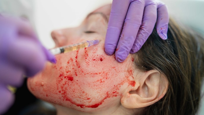 Close-up photo of doctor applying blood plasma during PRP vampire facelift.