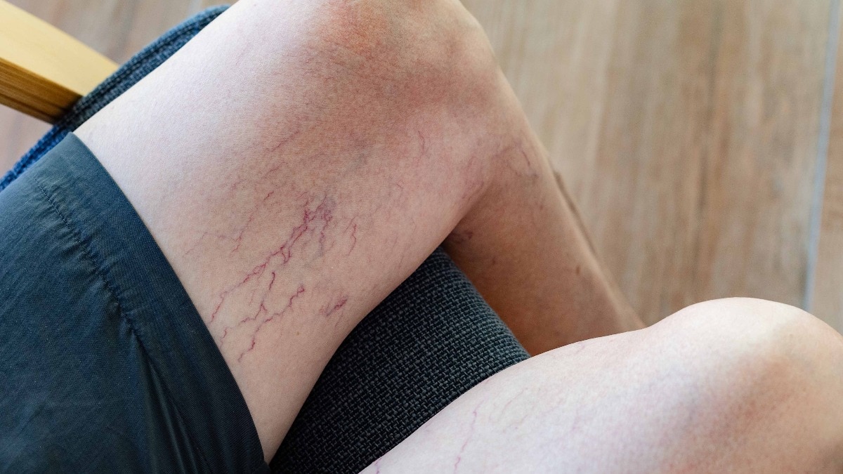 What are varicose veins, a condition affecting nearly 60% of women worldwide?