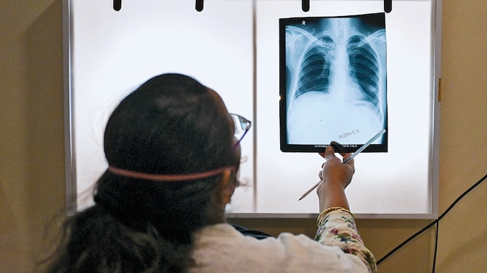 Tuberculosis | The new weapon against TB
