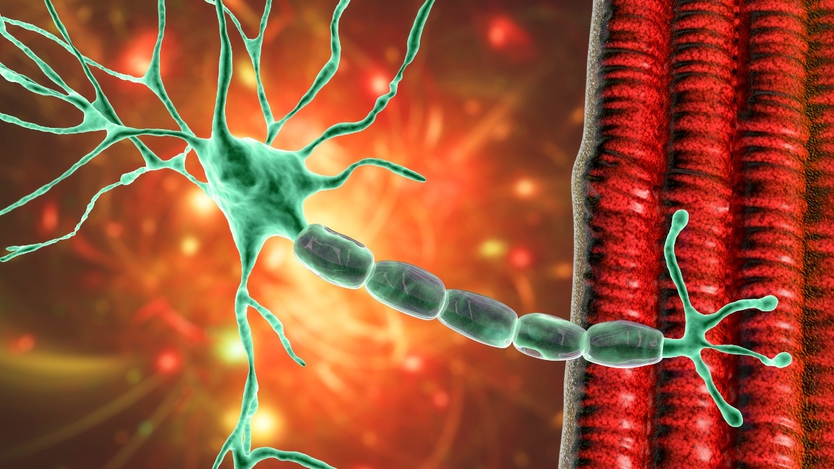 Guillain-Barré syndrome is a neurological disorder. (Photo: Getty Images) Guillain-Barré syndrome