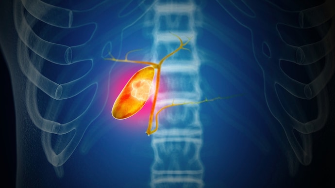 Cholesterol -rich stone with these toxic metals create a more dangerous environment inside the gallbladder. (Photo: Getty Image) Cholecystation