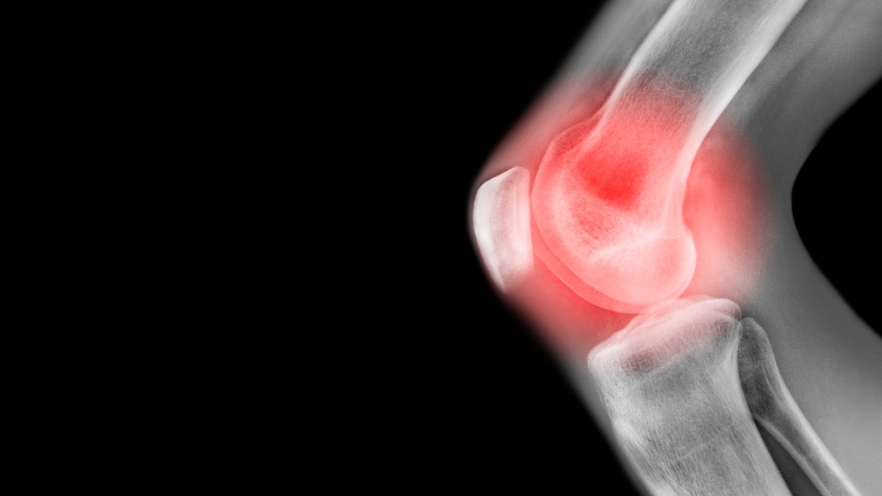 Scientists develop drug that may regrow knee cartilage and stop arthritis