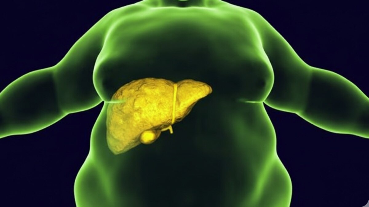 Fatty liver is India's silent epidemic, linked to diabetes and heart disease