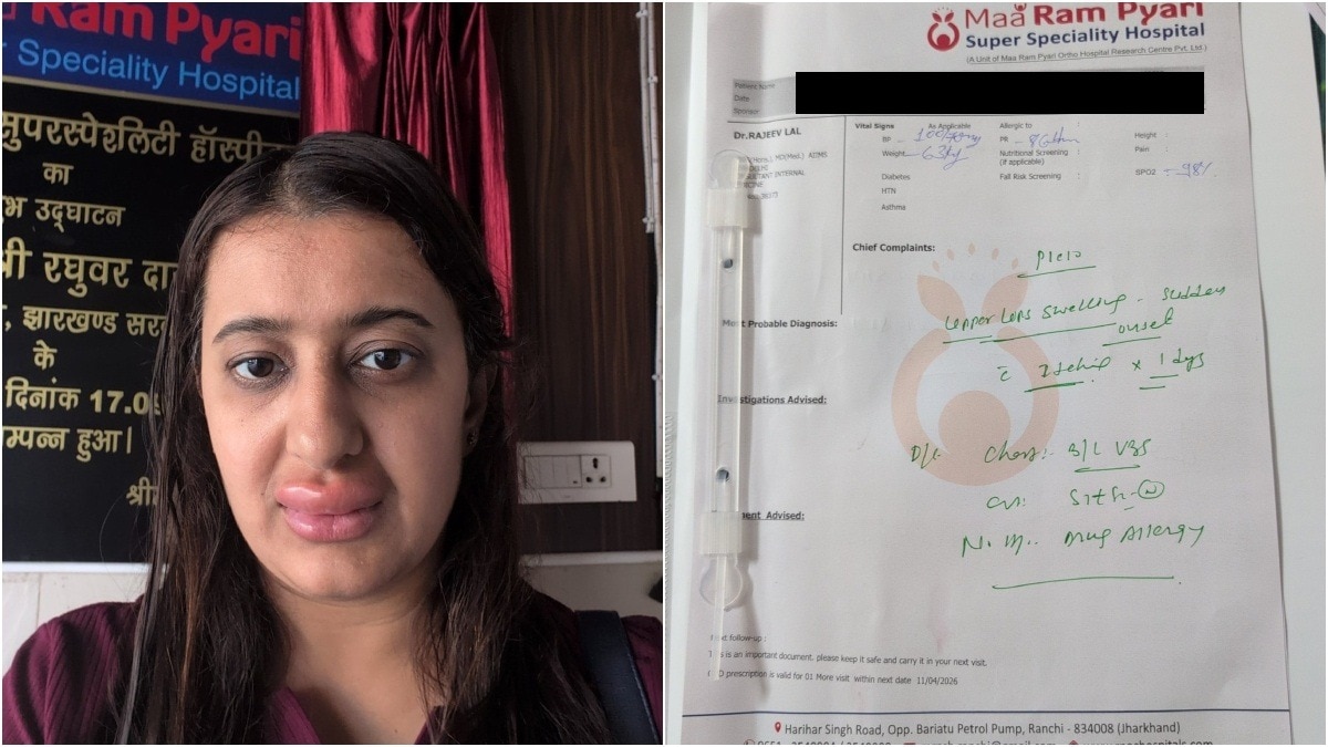 Ayushi Singh claimed to experience severe allergies after consuming food aboard Vande Bharat. (Photo: X) vande bharat meal