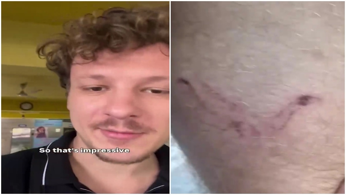 German man praises India’s healthcare after getting free treatment for dog bite German man praises India’s healthcare after getting free treatment for dog bite