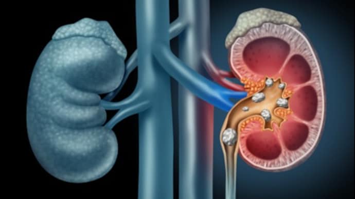 Symptoms of Kidney Stones includes severe abdominal or back pain, blood in urine, or difficulty urinating. Photo: Getty Images Symptoms of Kidney Stones includes severe abdominal or back pain, blood in urine, or difficulty urinating. Photo: Getty Images