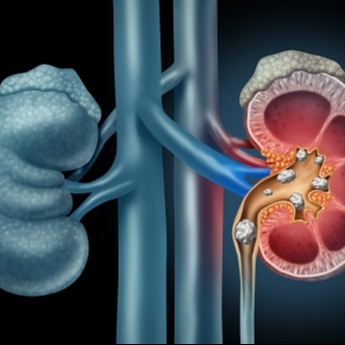 Doctors warn AC rooms can quietly raise kidney stone risk